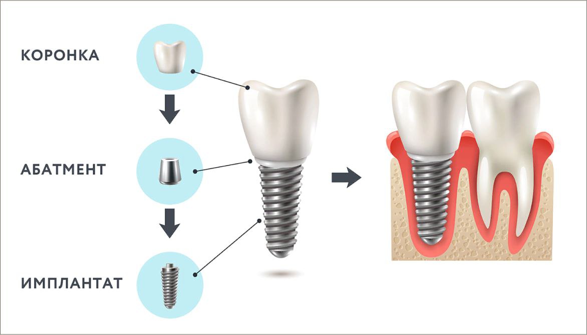 KESH MEDICAL PLAZA sizni implant tish qo‘yish bo‘yicha bepul maslahatga taklif qiladi